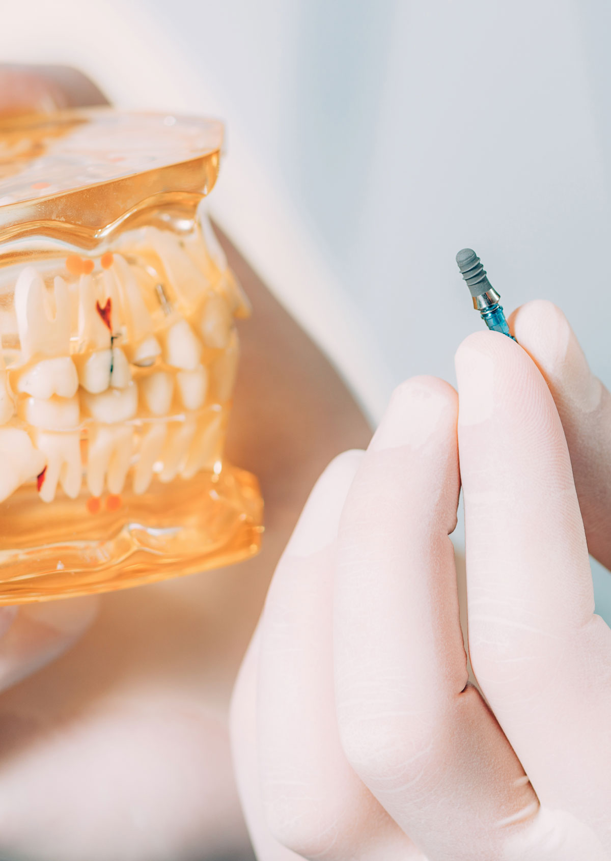 dental implants in Dubai