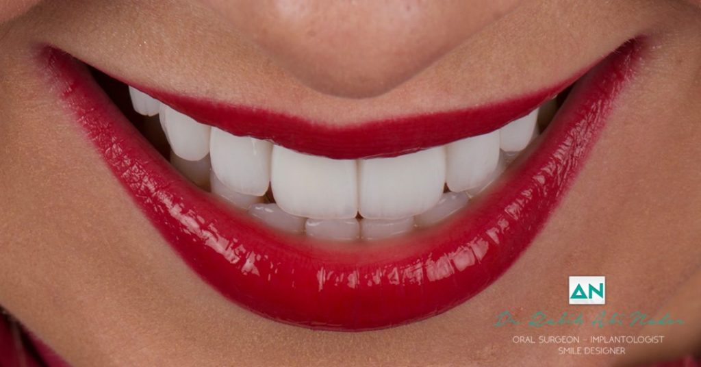Discover your perfect smile with veneers